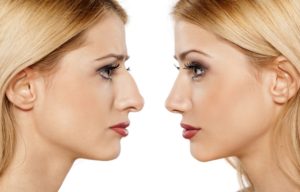 What Is Rhinoplasty And How It Is Done
