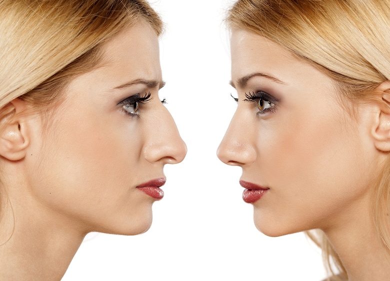 What Is Rhinoplasty And How It Is Done?