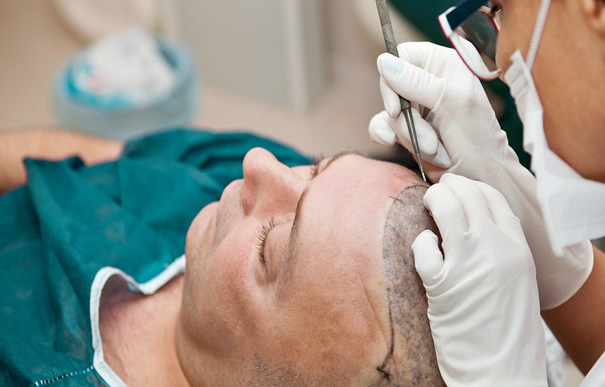 What Are The Reasons To Do Hair Transplant Treatment?