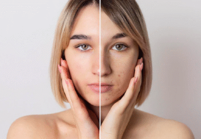 Uneven Skin Tone