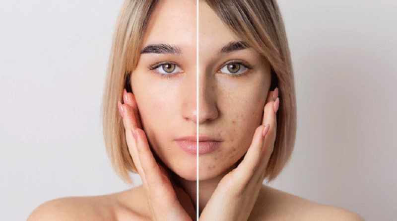 Uneven Skin Tone